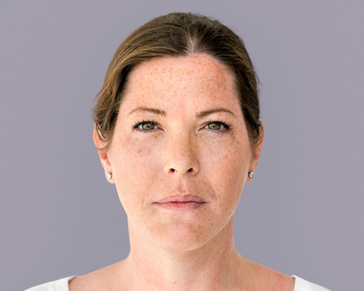 Woman with age spots (sun spots) on face — facial hyperpigmentation example for age-spot treatment and fading skincare.