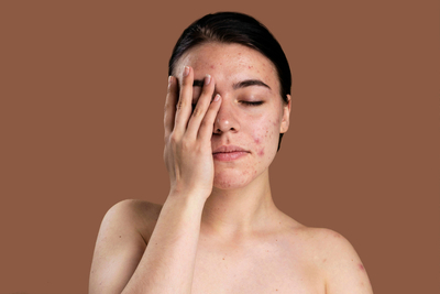 Frustrated woman with fungal acne on her face, highlighting misdiagnosed breakouts caused by Malassezia and common skincare mistakes
