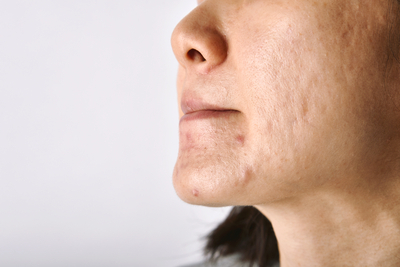 Acne scars on skin showing different types including atrophic and textural changes